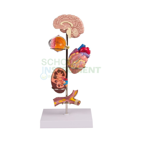 Human Hypertension Model, 6 Parts
